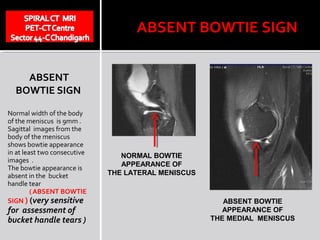 ABSENT BOWTIE SIGN


    ABSENT
  BOWTIE SIGN

Normal width of the body
of the meniscus is 9mm .
Sagittal images from the
body of the meniscus
shows bowtie appearance
in at least two consecutive      NORMAL BOWTIE
images .
                                 APPEARANCE OF
The bowtie appearance is
absent in the bucket          THE LATERAL MENISCUS
handle tear
         ( ABSENT BOWTIE
SIGN ) (very sensitive                                  ABSENT BOWTIE
for assessment of                                       APPEARANCE OF
bucket handle tears )                                THE MEDIAL MENISCUS
 