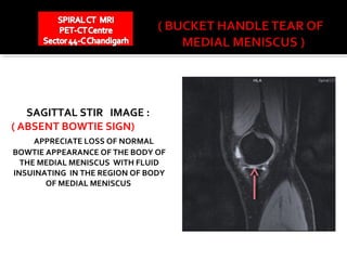 SAGITTAL STIR IMAGE :
( ABSENT BOWTIE SIGN)
     APPRECIATE LOSS OF NORMAL
BOWTIE APPEARANCE OF THE BODY OF
  THE MEDIAL MENISCUS WITH FLUID
INSUINATING IN THE REGION OF BODY
       OF MEDIAL MENISCUS
 