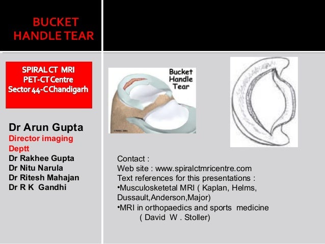Bucket handle tear Bucket handle tear