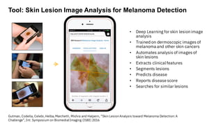 Gutman, Codella, Celebi, Helba, Marchetti, Mishra and Halpern, “Skin LesionAnalysis toward Melanoma Detection:A
Challenge”, Int. Symposium on Biomedial Imaging (ISBI) 2016
• Deep Learning for skin lesion image
analysis
• Trained on dermoscopic images of
melanoma and other skin cancers
• Automates analysis of images of
skin lesions
• Extracts clinical features
• Segments lesions
• Predicts disease
• Reports disease score
• Searches for similar lesions
Tool: Skin Lesion Image Analysis for Melanoma Detection
 