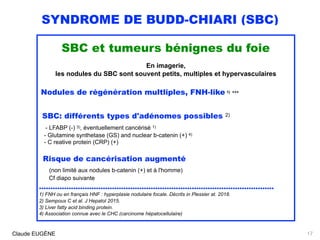SYNDROME DE BUDD-CHIARI (SBC)
SBC et tumeurs bénignes du foie
En imagerie,
les nodules du SBC sont souvent petits, multiples et hypervasculaires
Nodules de régénération multliples, FNH-like 1) +++
SBC: différents types d'adénomes possibles 2)
- LFABP (-) 3), éventuellement cancérisé 1)
- Glutamine synthetase (GS) and nuclear b-catenin (+) 4)
- C reative protein (CRP) (+)
 
Risque de cancérisation augmenté 
(non limité aux nodules b-catenin (+) et à l'homme) 
Cf diapo suivante
.......................................................................................................
1) FNH ou en français HNF : hyperplasie nodulaire focale. Décrits in Plessier at. 2018.
2) Sempoux C et al. J Hepatol 2015. 
3) Liver fatty acid binding protein. 
4) Association connue avec le CHC (carcinome hépatocellulaire)
Claude EUGÈNE 17
 