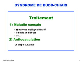 SYNDROME DE BUDD-CHIARI
Traitement
1) Maladie causale
- Syndrome myéloprolifératif
- Maladie de Behçet
- etc ...
2) Anticoagulation 
Cf diapo suivante
Claude EUGÈNE 20
 