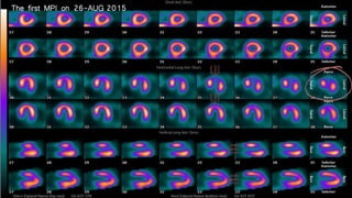 The first MPI on 26-AUG 2015
 