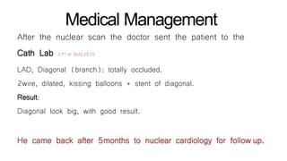 Medical Management
After the nuclear scan the doctor sent the patient to the
Cath Lab 27th of AUG2015
LAD, Diagonal (branch): totally occluded.
2wire, dilated, kissing balloons + stent of diagonal.
Result:
Diagonal look big, with good result.
He came back after 5months to nuclear cardiology for follow up.
 