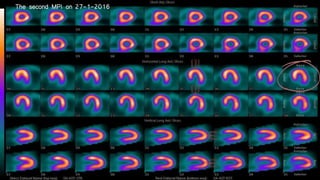 The second MPI on 27-1-2016
 