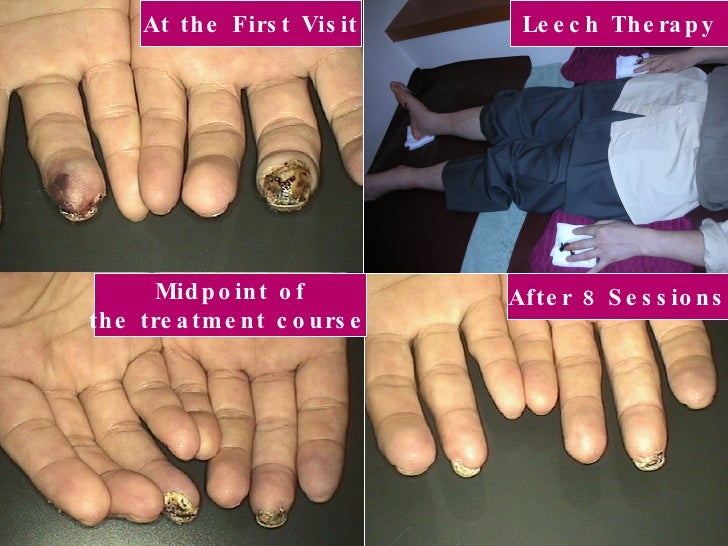 Buergers Disease Leech Therapy