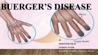 BUERGER’S DISEASE
BY
MR.RAVISHANKAR
NURSING TUTOR
OJASWINI NURSING COLLEGE, SAGAR
 