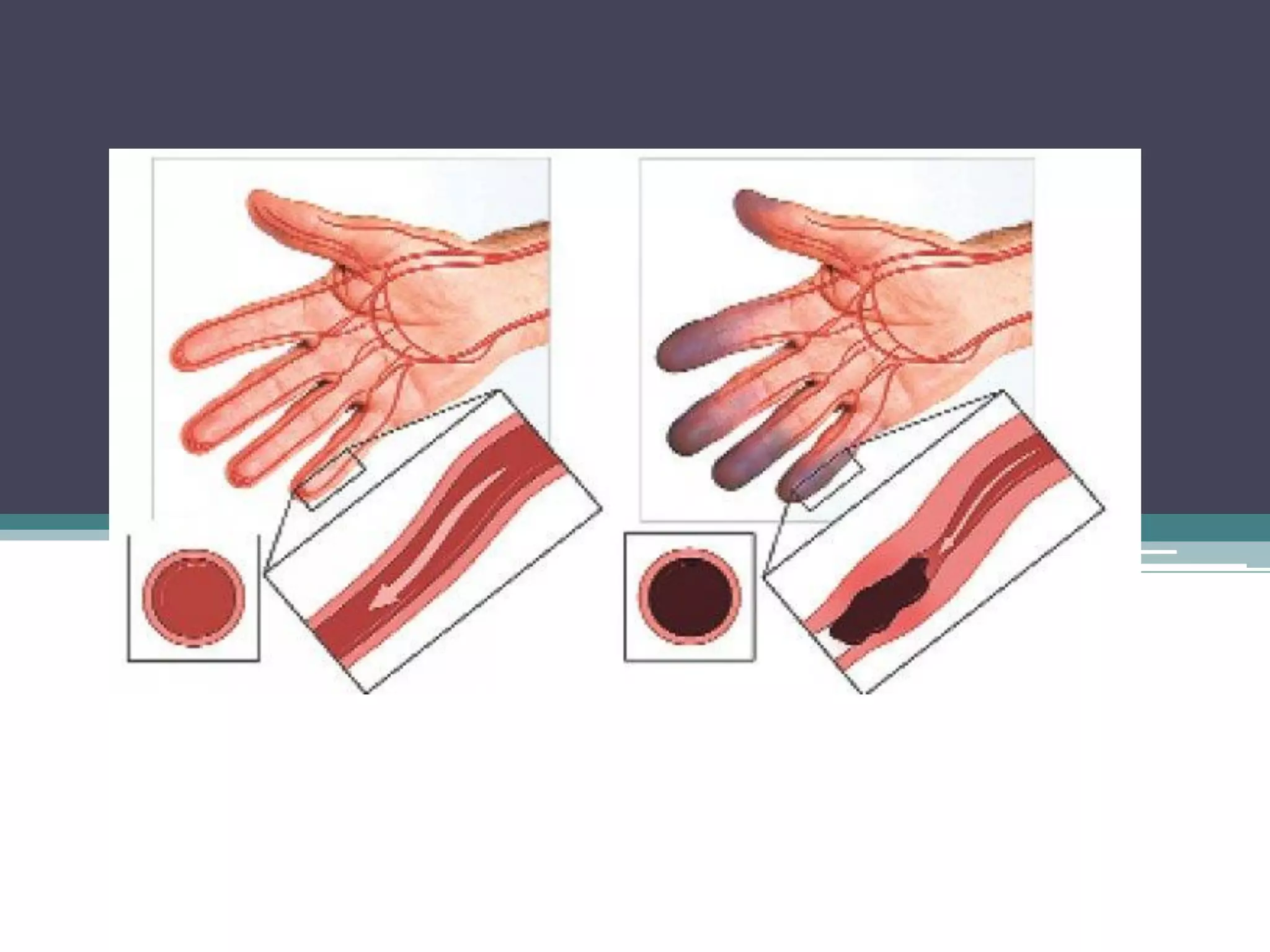 Buerger's disease ( Thromboangiitis obliterans) PPT