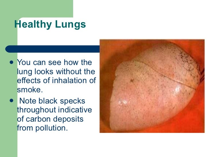 Buergers disease by dr .ravinder narwal