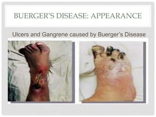 BUERGER’S DISEASE: APPEARANCE
Ulcers and Gangrene caused by Buerger’s Disease
 