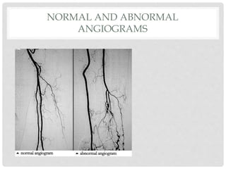 NORMAL AND ABNORMAL
ANGIOGRAMS
 