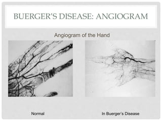 BUERGER’S DISEASE: ANGIOGRAM
Angiogram of the Hand
Normal In Buerger’s Disease
 