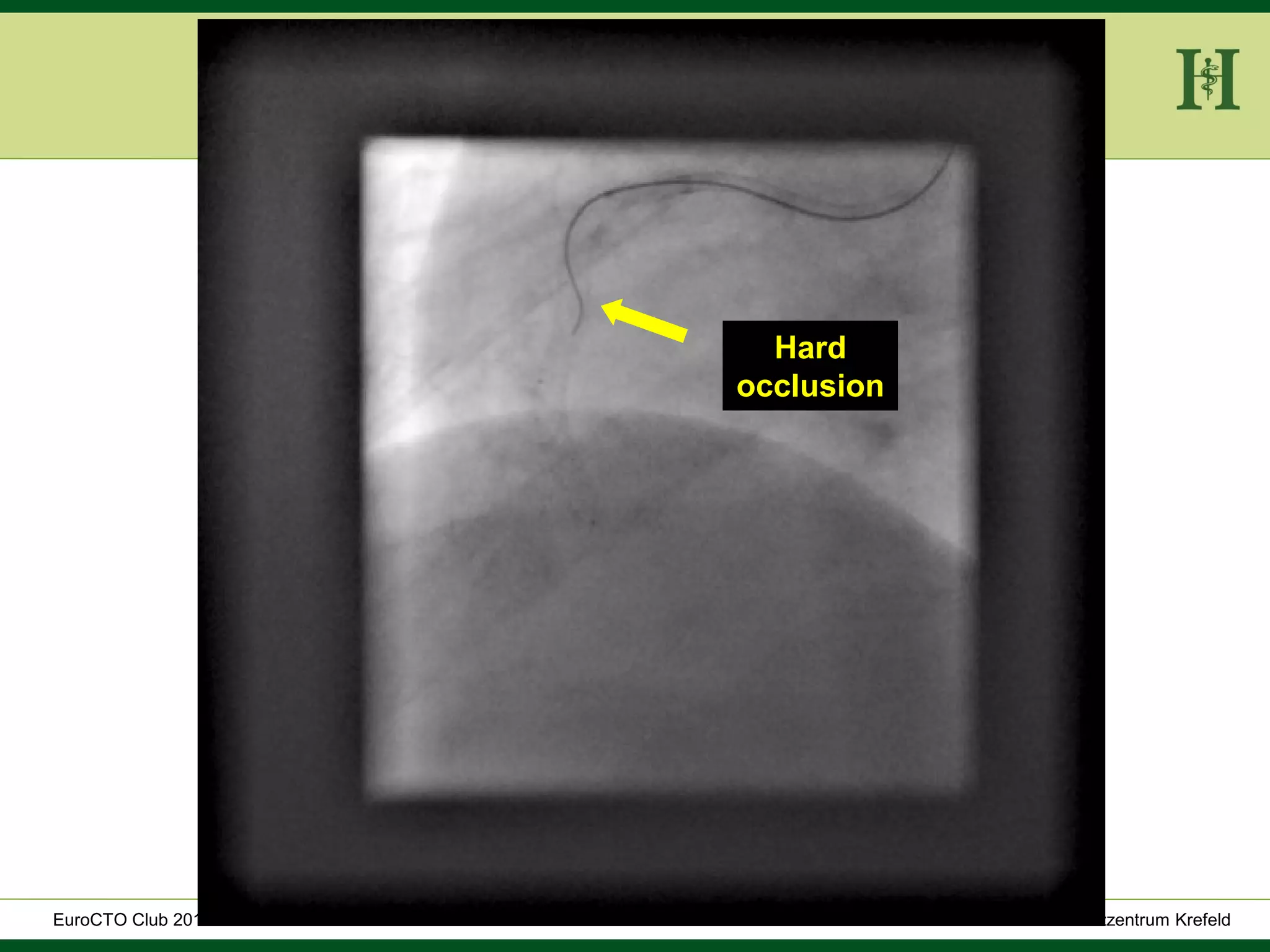 HELIOS Klinikum Wuppertal - HerzzentrumHELIOS Klinikum Wuppertal - Herzzentru
A. Bufe - HELIOS Herzzentrum KrefeldEuroCTO Club 2016
Hard
occlusion
 