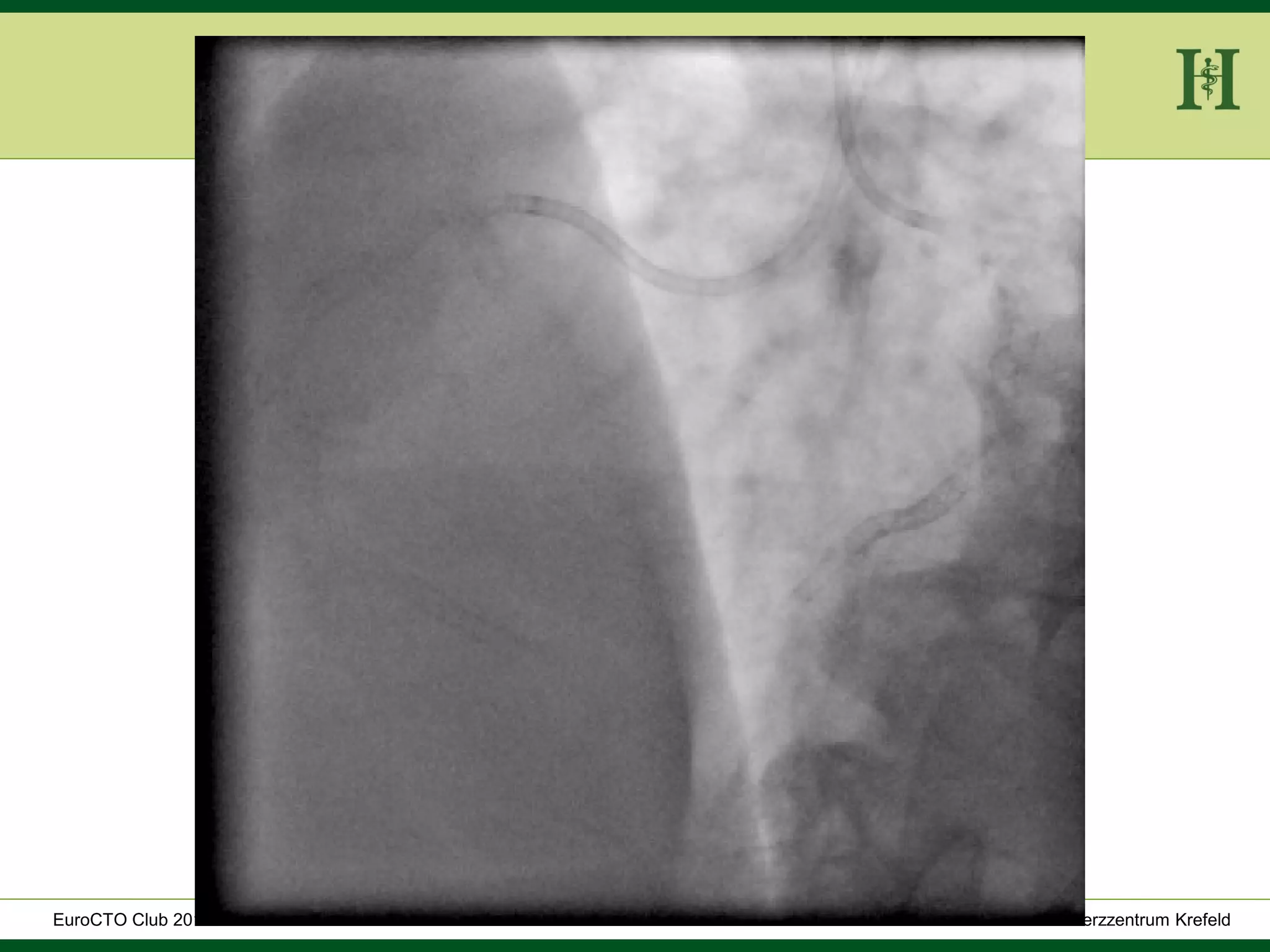 HELIOS Klinikum Wuppertal - HerzzentrumHELIOS Klinikum Wuppertal - Herzzentru
A. Bufe - HELIOS Herzzentrum KrefeldEuroCTO Club 2016
 