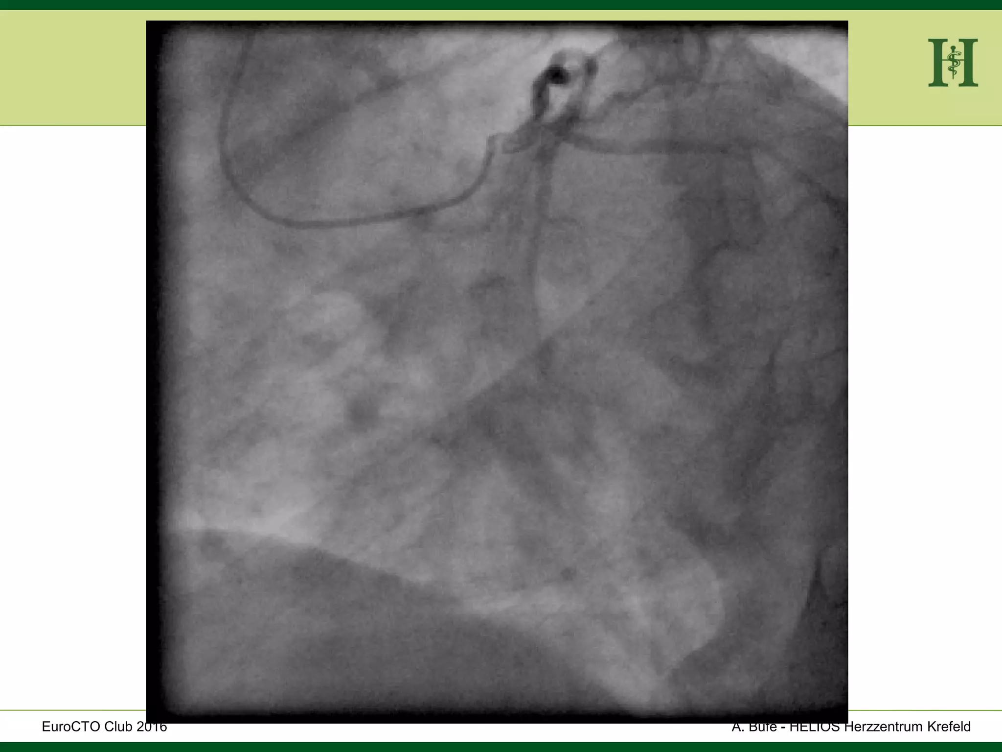 HELIOS Klinikum Wuppertal - HerzzentrumHELIOS Klinikum Wuppertal - Herzzentru
A. Bufe - HELIOS Herzzentrum KrefeldEuroCTO Club 2016
 