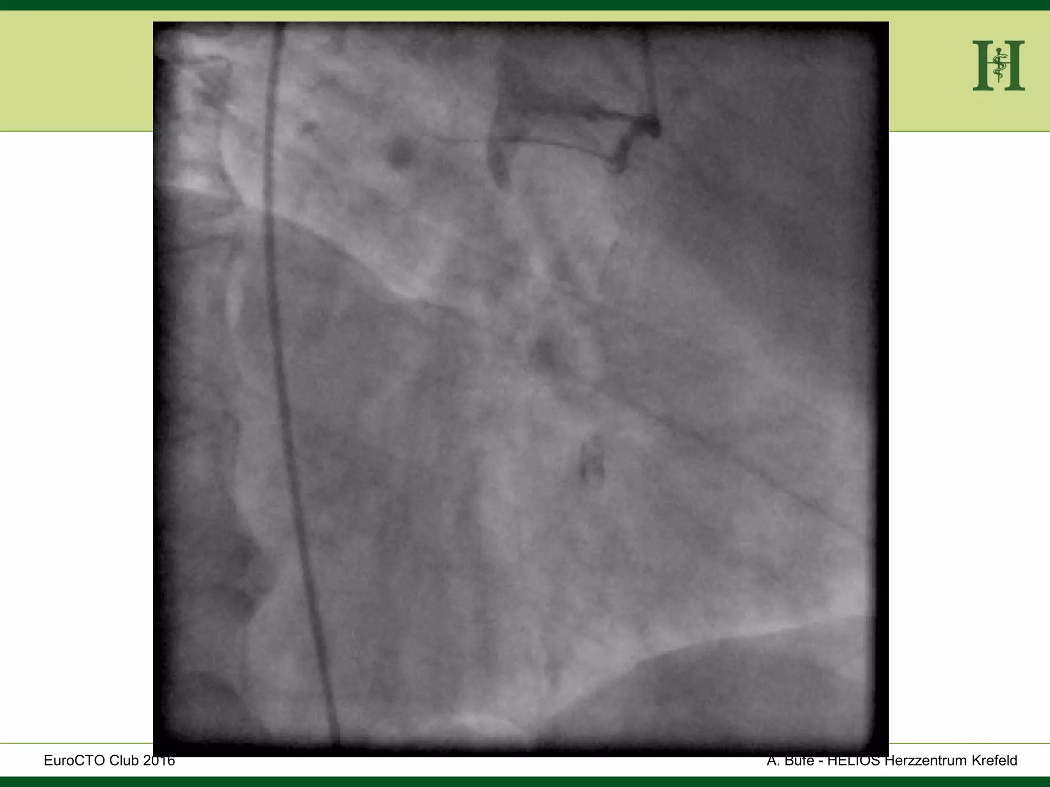 HELIOS Klinikum Wuppertal - HerzzentrumHELIOS Klinikum Wuppertal - Herzzentru
A. Bufe - HELIOS Herzzentrum KrefeldEuroCTO Club 2016
 