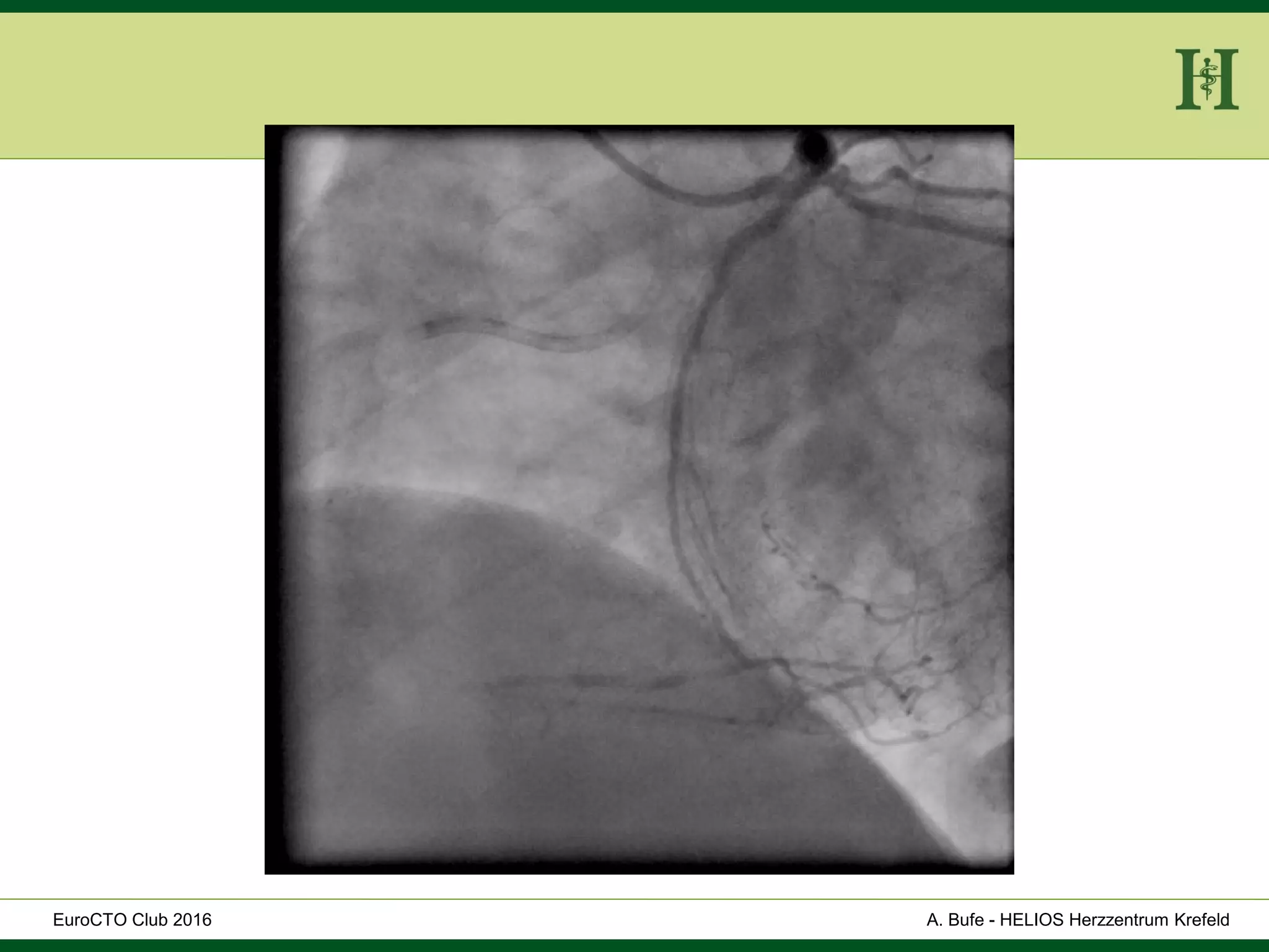 HELIOS Klinikum Wuppertal - HerzzentrumHELIOS Klinikum Wuppertal - Herzzentru
A. Bufe - HELIOS Herzzentrum KrefeldEuroCTO Club 2016
 