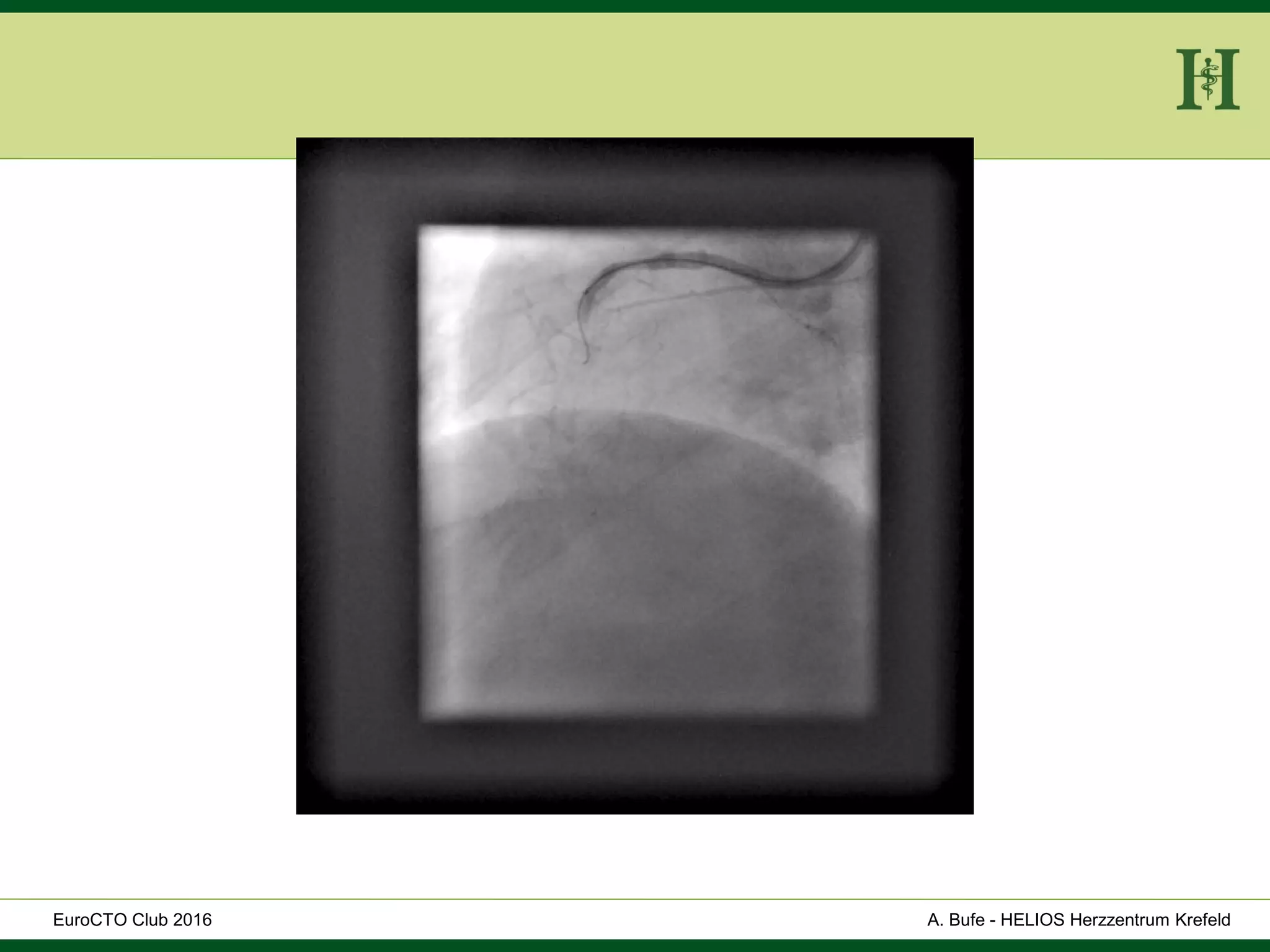HELIOS Klinikum Wuppertal - HerzzentrumHELIOS Klinikum Wuppertal - Herzzentru
A. Bufe - HELIOS Herzzentrum KrefeldEuroCTO Club 2016
 