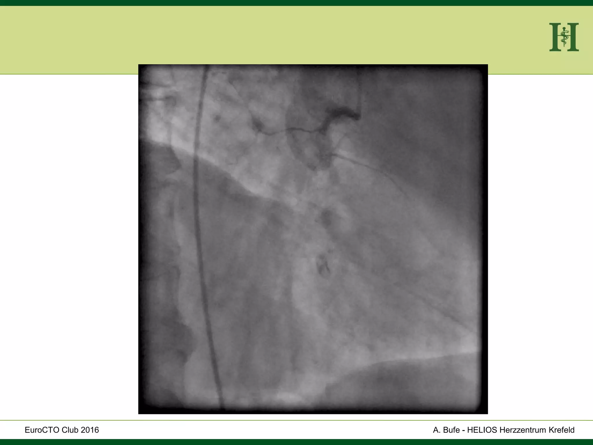 HELIOS Klinikum Wuppertal - HerzzentrumHELIOS Klinikum Wuppertal - Herzzentru
A. Bufe - HELIOS Herzzentrum KrefeldEuroCTO Club 2016
 
