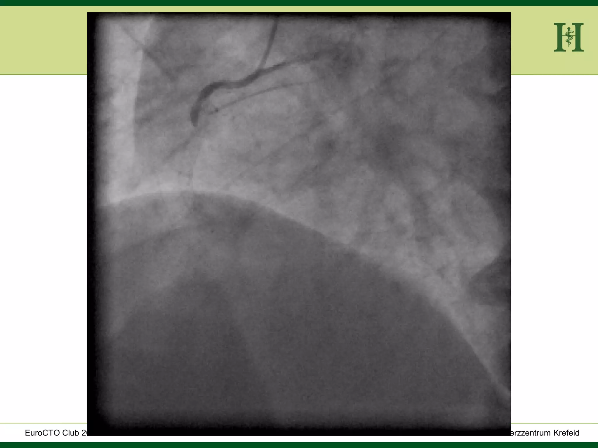 HELIOS Klinikum Wuppertal - HerzzentrumHELIOS Klinikum Wuppertal - Herzzentru
A. Bufe - HELIOS Herzzentrum KrefeldEuroCTO Club 2016
 