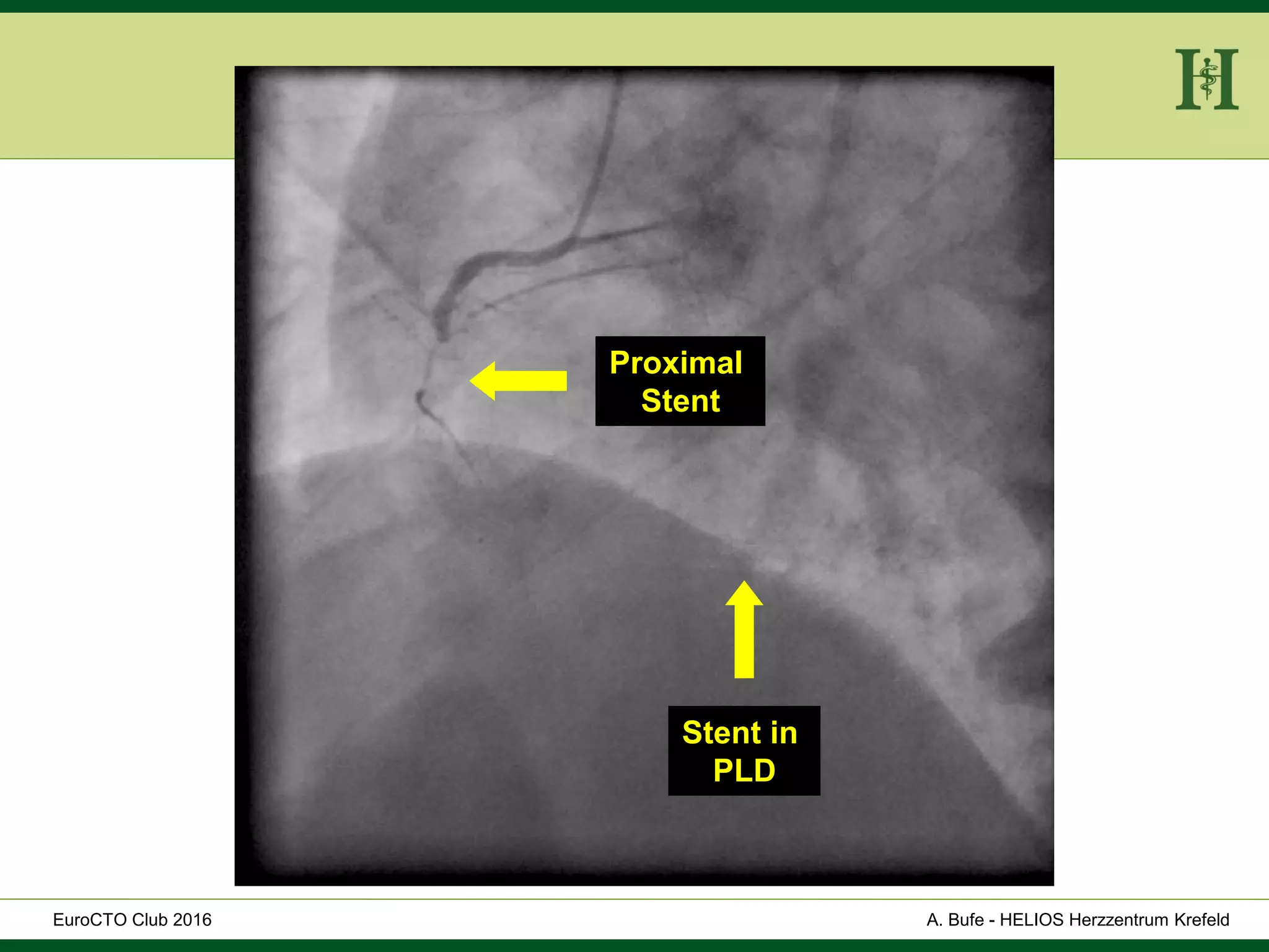 HELIOS Klinikum Wuppertal - HerzzentrumHELIOS Klinikum Wuppertal - Herzzentru
A. Bufe - HELIOS Herzzentrum KrefeldEuroCTO Club 2016
Proximal
Stent
Stent in
PLD
 
