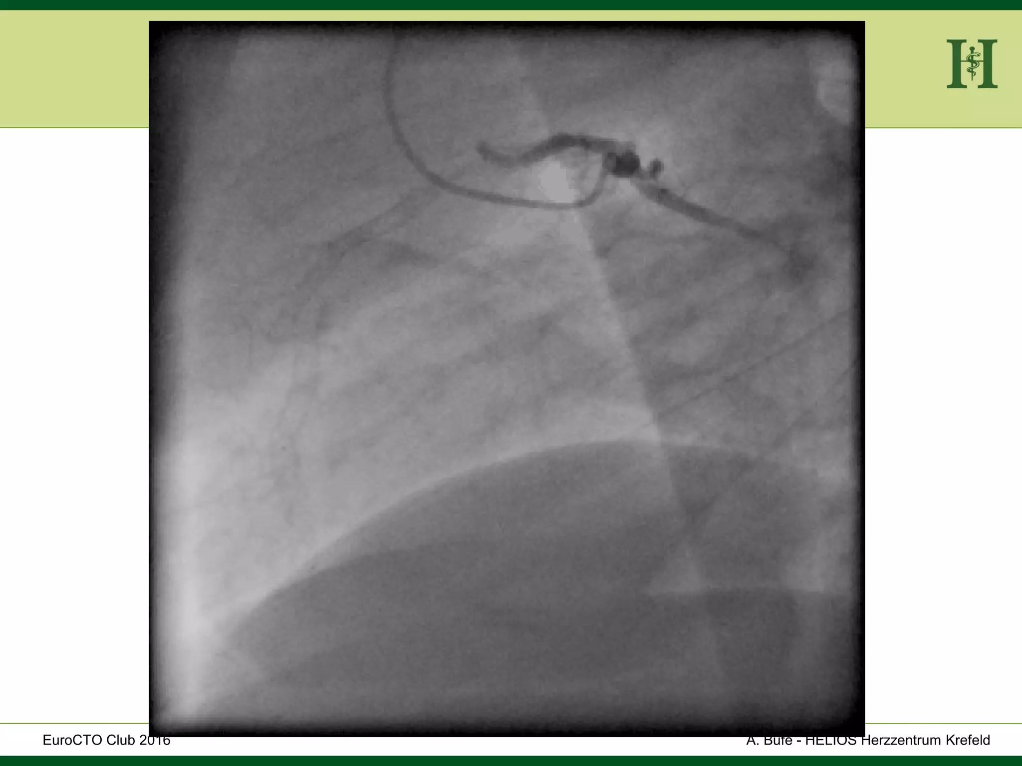 HELIOS Klinikum Wuppertal - HerzzentrumHELIOS Klinikum Wuppertal - Herzzentru
A. Bufe - HELIOS Herzzentrum KrefeldEuroCTO Club 2016
 