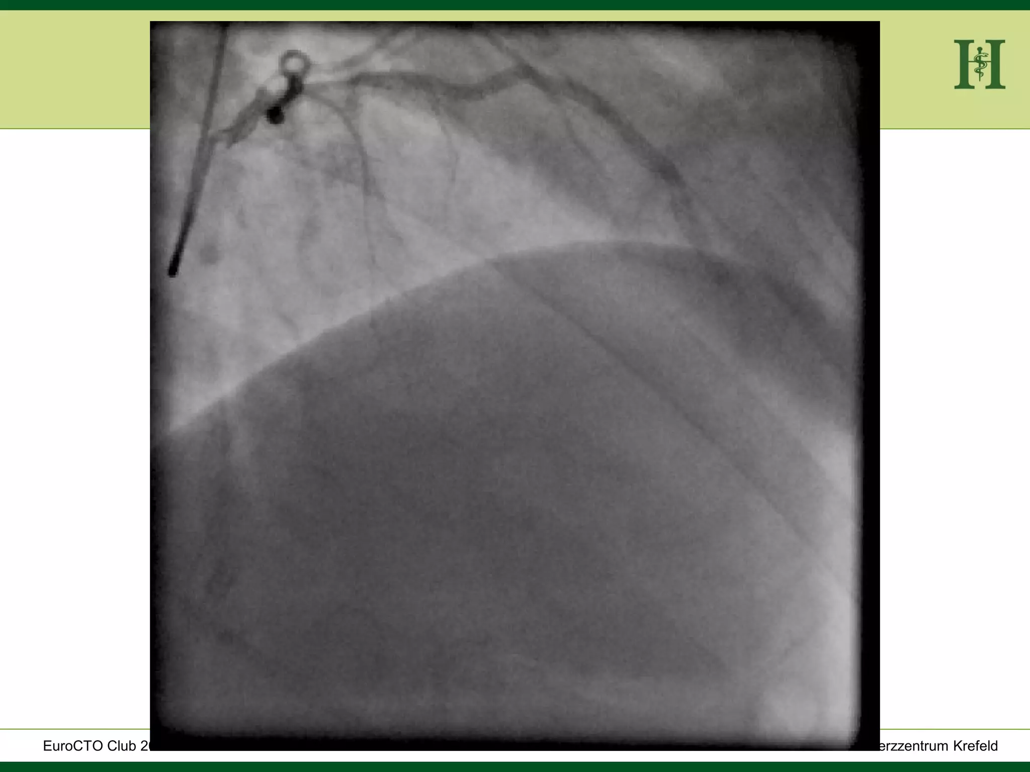HELIOS Klinikum Wuppertal - HerzzentrumHELIOS Klinikum Wuppertal - Herzzentru
A. Bufe - HELIOS Herzzentrum KrefeldEuroCTO Club 2016
 
