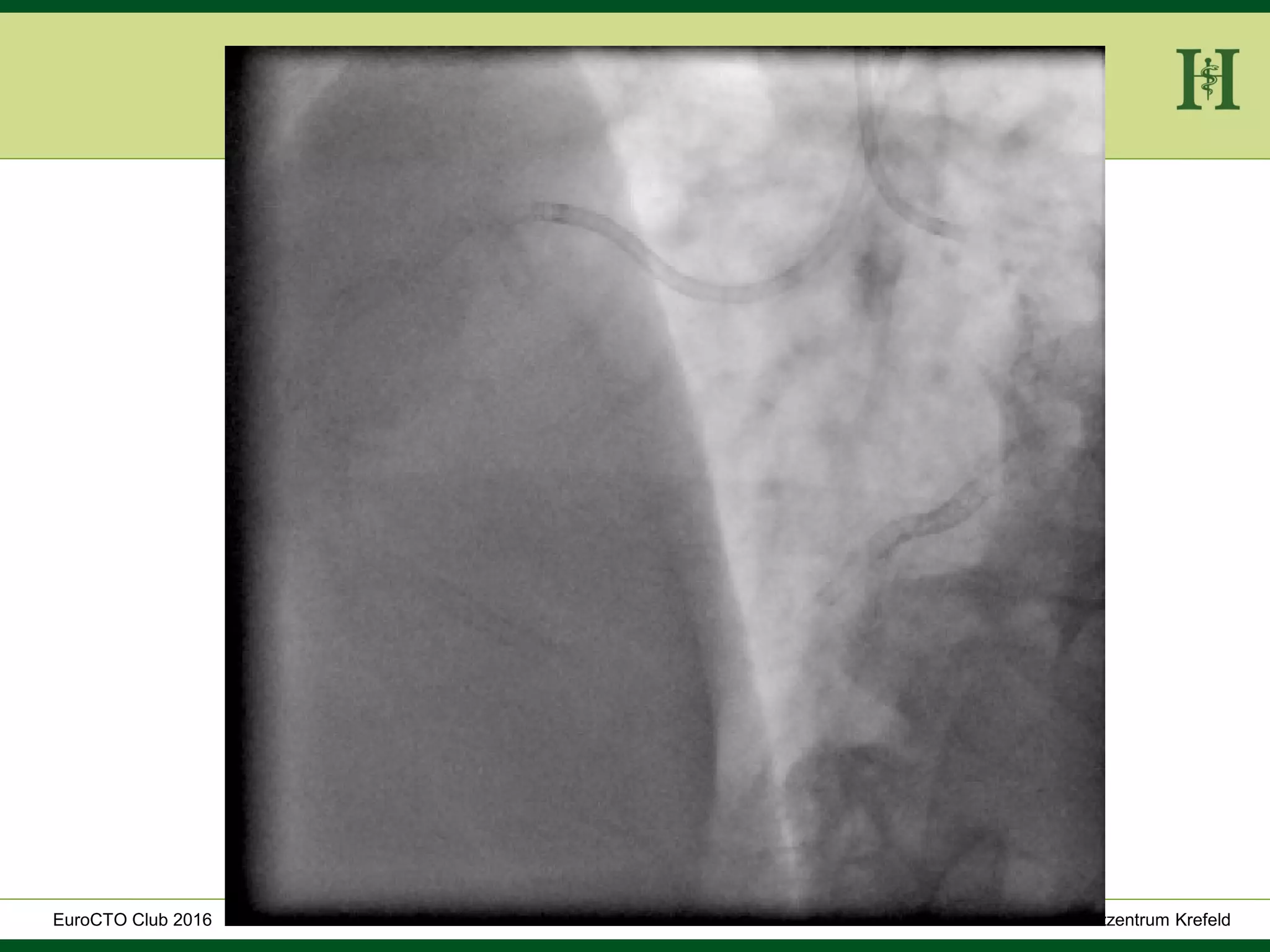 HELIOS Klinikum Wuppertal - HerzzentrumHELIOS Klinikum Wuppertal - Herzzentru
A. Bufe - HELIOS Herzzentrum KrefeldEuroCTO Club 2016
 
