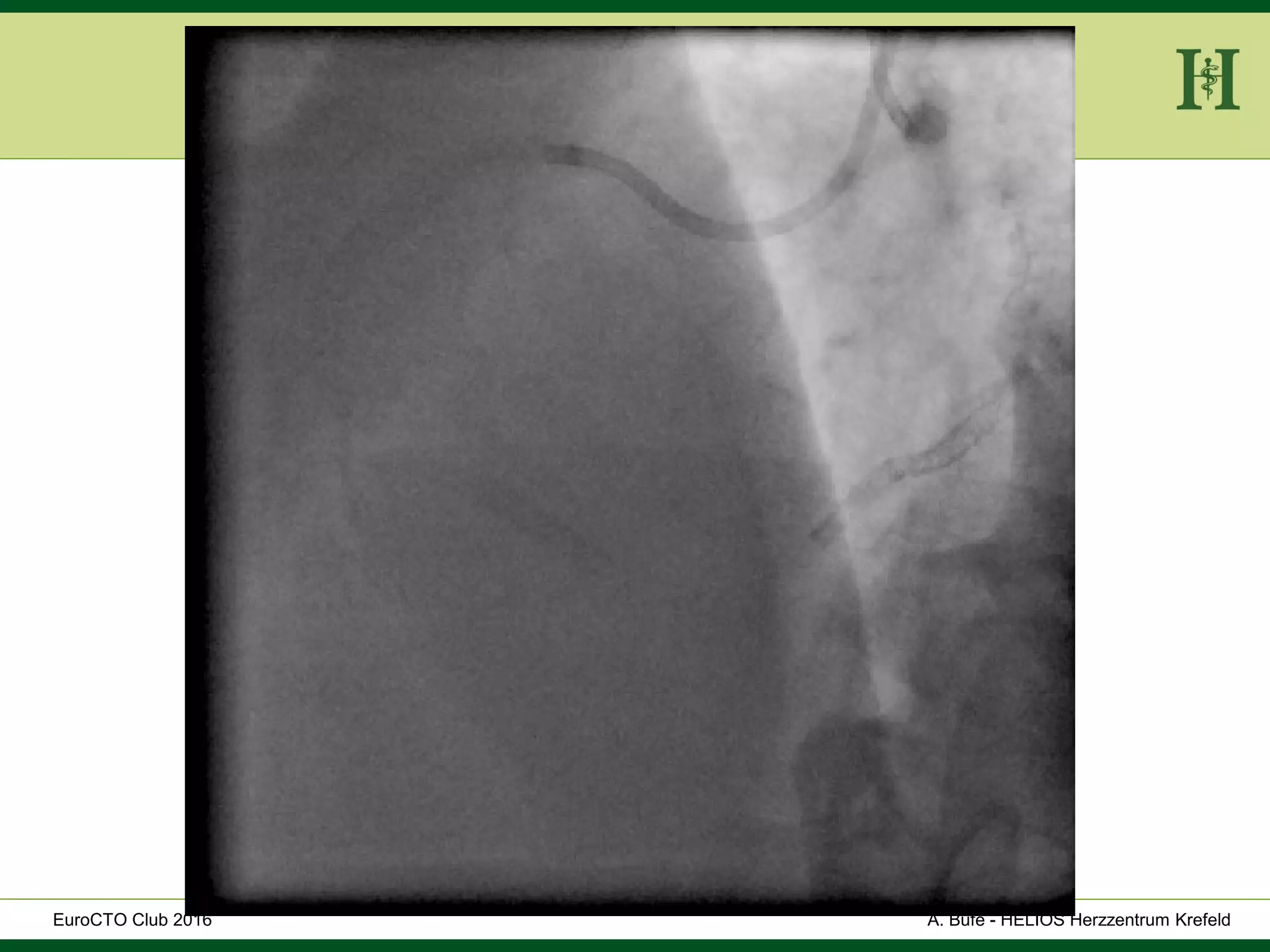 HELIOS Klinikum Wuppertal - HerzzentrumHELIOS Klinikum Wuppertal - Herzzentru
A. Bufe - HELIOS Herzzentrum KrefeldEuroCTO Club 2016
 