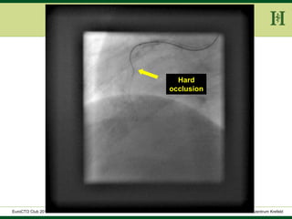 HELIOS Klinikum Wuppertal - HerzzentrumHELIOS Klinikum Wuppertal - Herzzentru
A. Bufe - HELIOS Herzzentrum KrefeldEuroCTO Club 2016
Hard
occlusion
 
