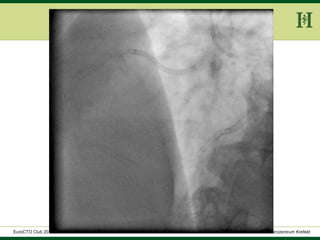 HELIOS Klinikum Wuppertal - HerzzentrumHELIOS Klinikum Wuppertal - Herzzentru
A. Bufe - HELIOS Herzzentrum KrefeldEuroCTO Club 2016
 