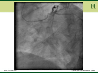 HELIOS Klinikum Wuppertal - HerzzentrumHELIOS Klinikum Wuppertal - Herzzentru
A. Bufe - HELIOS Herzzentrum KrefeldEuroCTO Club 2016
 