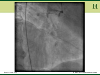 HELIOS Klinikum Wuppertal - HerzzentrumHELIOS Klinikum Wuppertal - Herzzentru
A. Bufe - HELIOS Herzzentrum KrefeldEuroCTO Club 2016
 