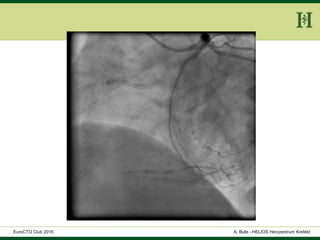 HELIOS Klinikum Wuppertal - HerzzentrumHELIOS Klinikum Wuppertal - Herzzentru
A. Bufe - HELIOS Herzzentrum KrefeldEuroCTO Club 2016
 