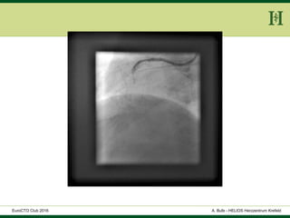 HELIOS Klinikum Wuppertal - HerzzentrumHELIOS Klinikum Wuppertal - Herzzentru
A. Bufe - HELIOS Herzzentrum KrefeldEuroCTO Club 2016
 