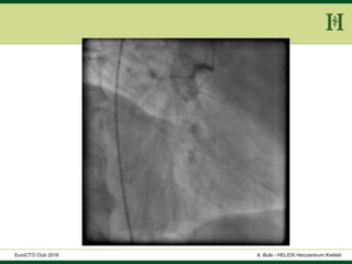 HELIOS Klinikum Wuppertal - HerzzentrumHELIOS Klinikum Wuppertal - Herzzentru
A. Bufe - HELIOS Herzzentrum KrefeldEuroCTO Club 2016
 