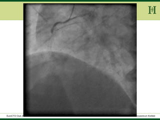 HELIOS Klinikum Wuppertal - HerzzentrumHELIOS Klinikum Wuppertal - Herzzentru
A. Bufe - HELIOS Herzzentrum KrefeldEuroCTO Club 2016
 