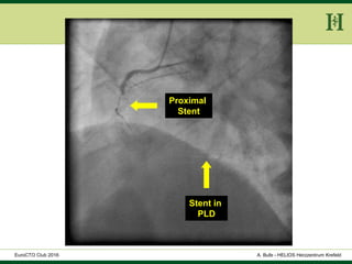 HELIOS Klinikum Wuppertal - HerzzentrumHELIOS Klinikum Wuppertal - Herzzentru
A. Bufe - HELIOS Herzzentrum KrefeldEuroCTO Club 2016
Proximal
Stent
Stent in
PLD
 