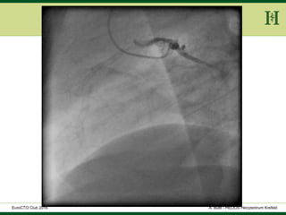 HELIOS Klinikum Wuppertal - HerzzentrumHELIOS Klinikum Wuppertal - Herzzentru
A. Bufe - HELIOS Herzzentrum KrefeldEuroCTO Club 2016
 