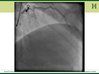 HELIOS Klinikum Wuppertal - HerzzentrumHELIOS Klinikum Wuppertal - Herzzentru
A. Bufe - HELIOS Herzzentrum KrefeldEuroCTO Club 2016
 