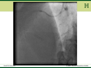 HELIOS Klinikum Wuppertal - HerzzentrumHELIOS Klinikum Wuppertal - Herzzentru
A. Bufe - HELIOS Herzzentrum KrefeldEuroCTO Club 2016
 