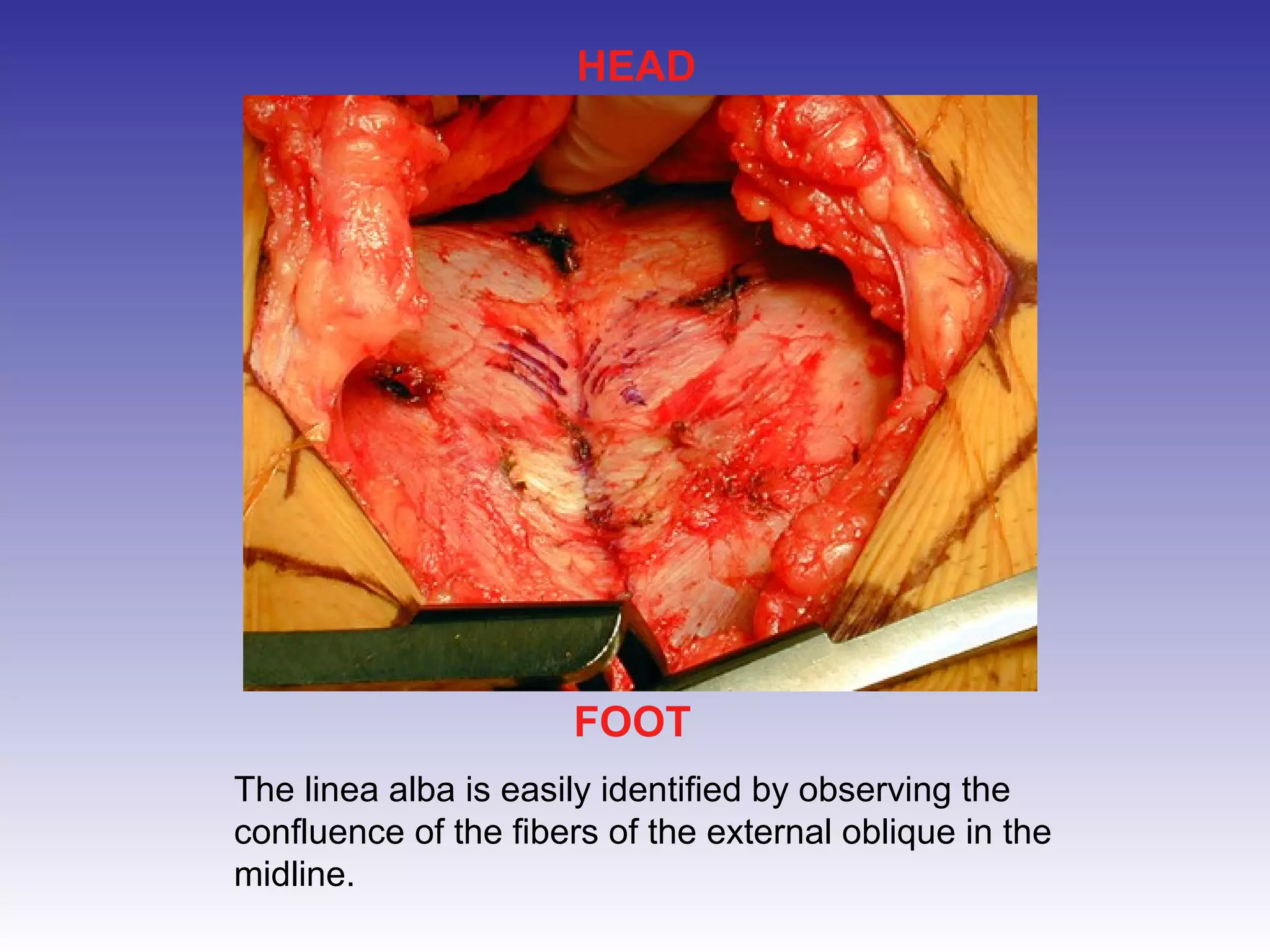 HEAD 
FOOT 
The linea alba is easily identified by observing the 
confluence of the fibers of the external oblique in the 
midline. 
 