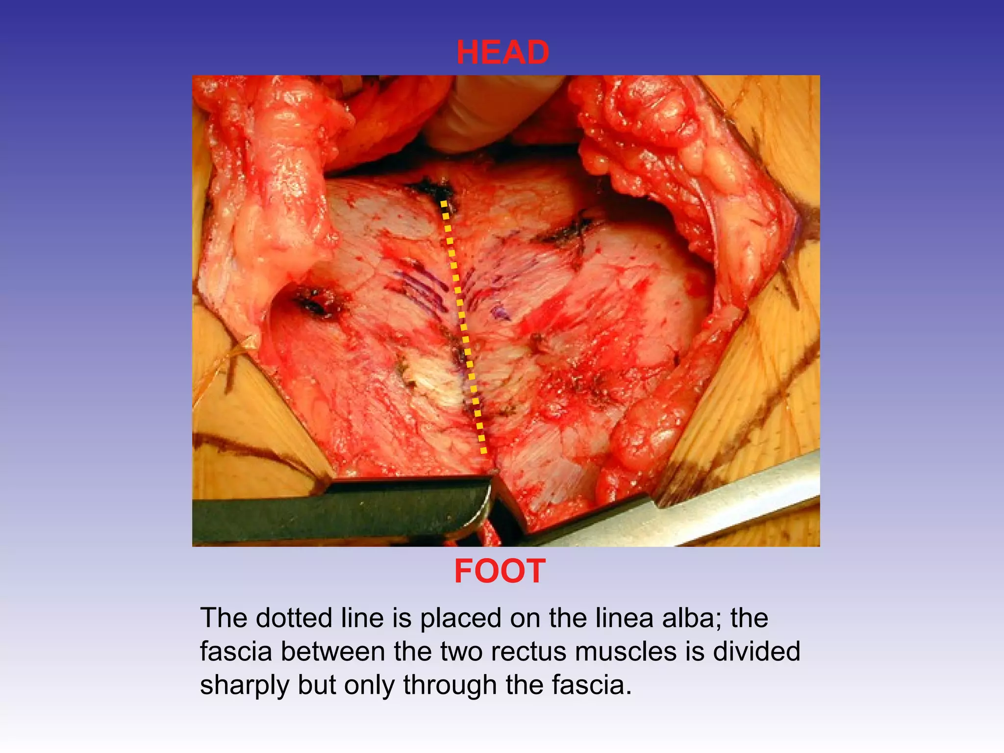 HEAD 
FOOT 
The dotted line is placed on the linea alba; the 
fascia between the two rectus muscles is divided 
sharply but only through the fascia. 
 