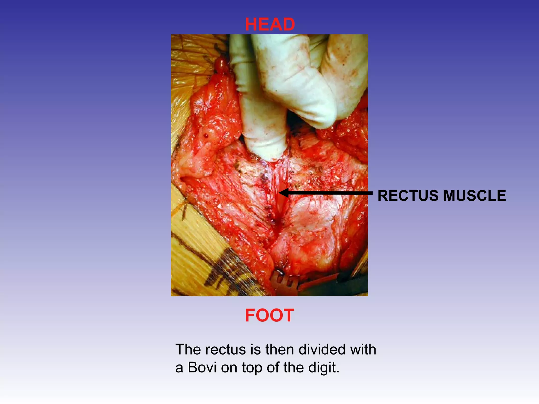 HEAD 
FOOT 
The rectus is then divided with 
a Bovi on top of the digit. 
RECTUS MUSCLE 
 