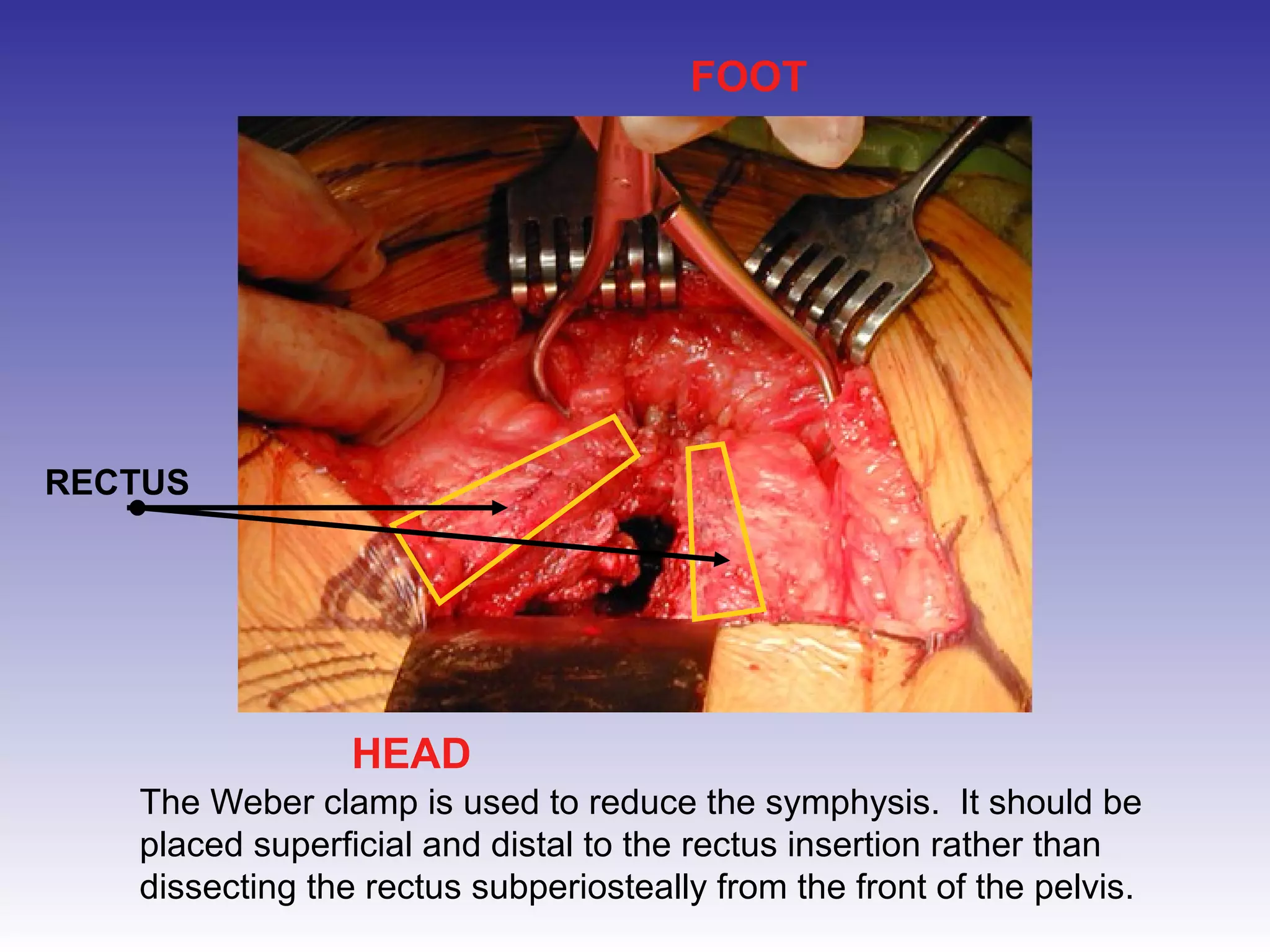 FOOT 
HEAD 
RECTUS 
The Weber clamp is used to reduce the symphysis. It should be 
placed superficial and distal to the rectus insertion rather than 
dissecting the rectus subperiosteally from the front of the pelvis. 
 