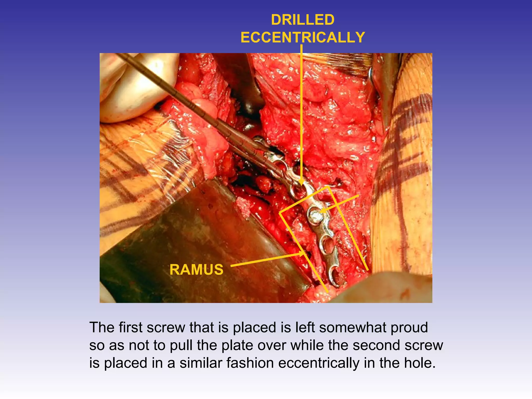 DRILLED 
ECCENTRICALLY 
RAMUS 
The first screw that is placed is left somewhat proud 
so as not to pull the plate over while the second screw 
is placed in a similar fashion eccentrically in the hole. 
 