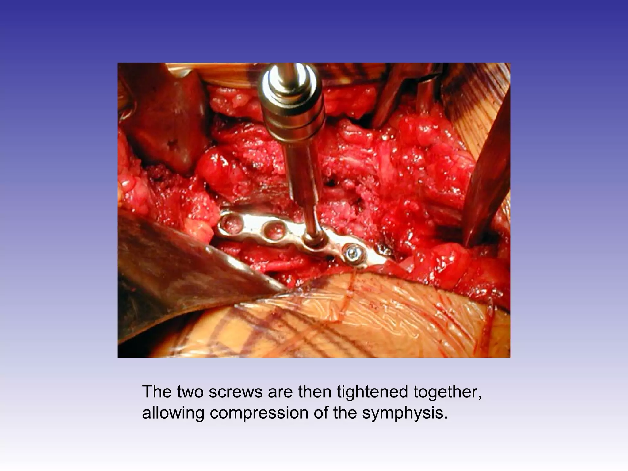 The two screws are then tightened together, 
allowing compression of the symphysis. 
 
