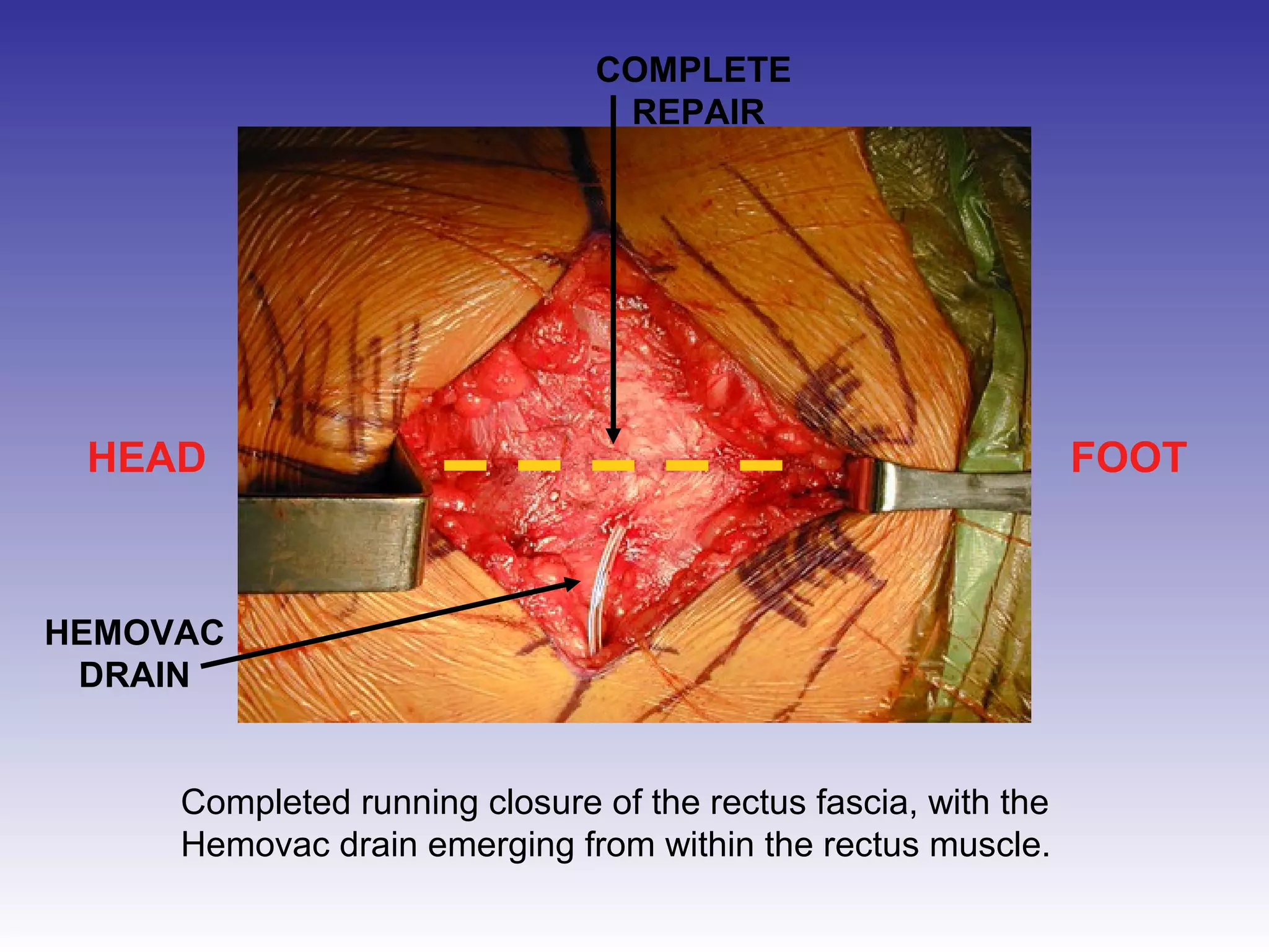 COMPLETE 
REPAIR 
HEAD FOOT 
HEMOVAC 
DRAIN 
Completed running closure of the rectus fascia, with the 
Hemovac drain emerging from within the rectus muscle. 
 
