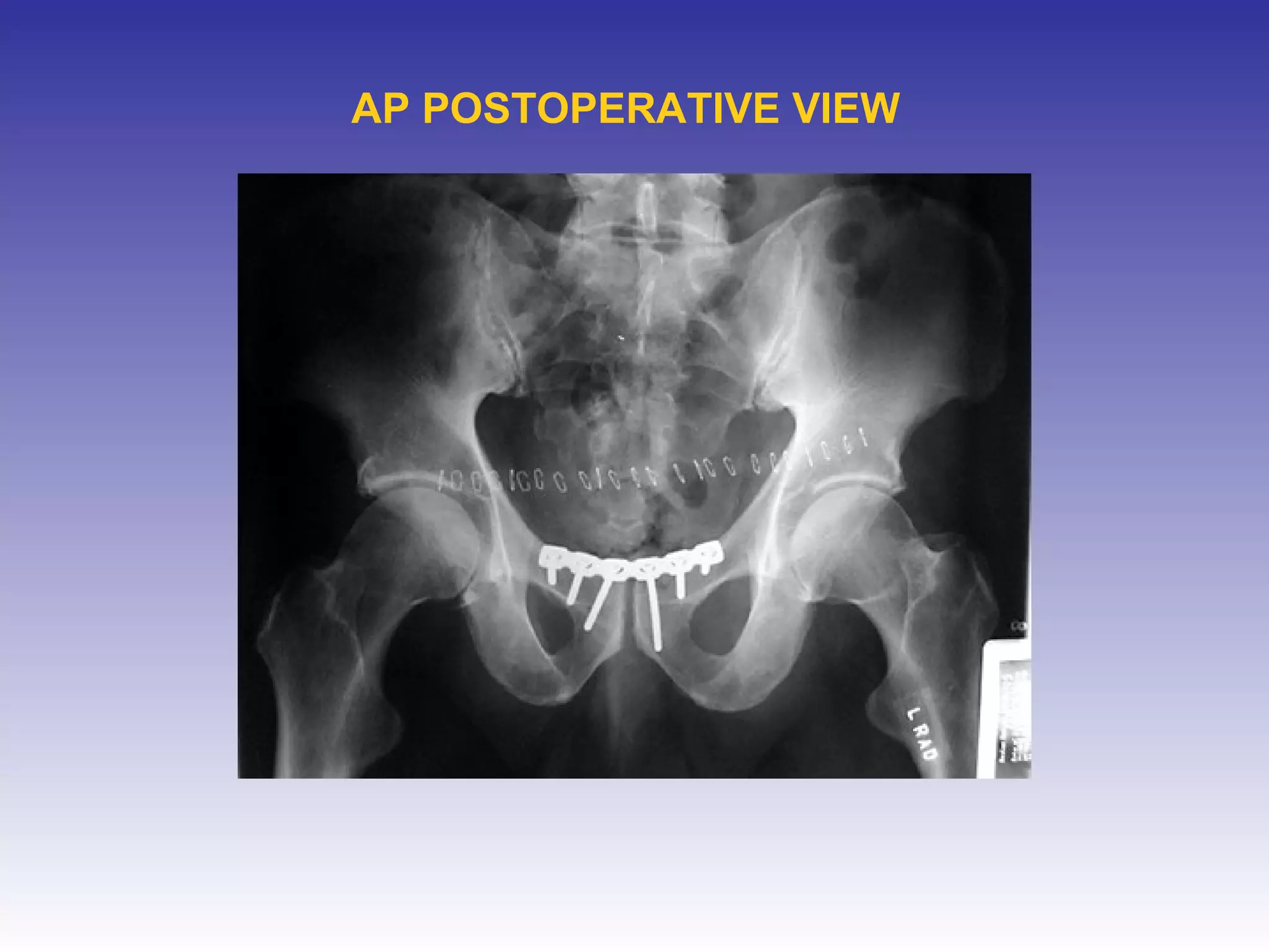 AP POSTOPERATIVE VIEW 
 