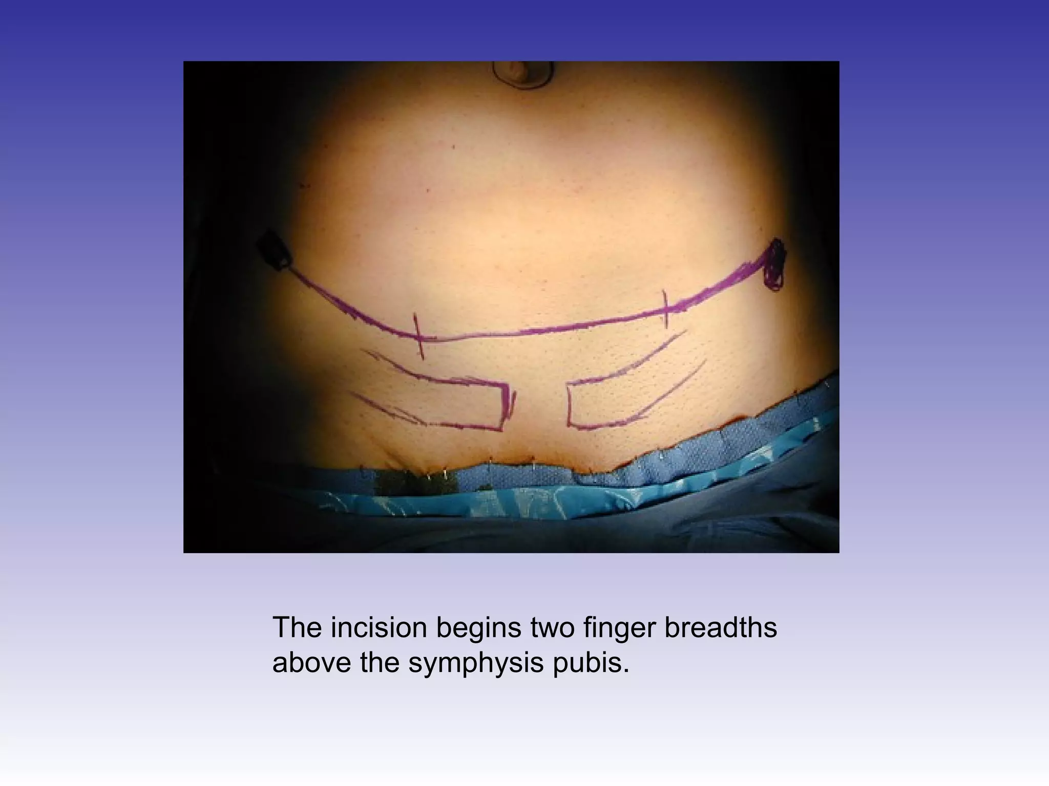The incision begins two finger breadths 
above the symphysis pubis. 
 